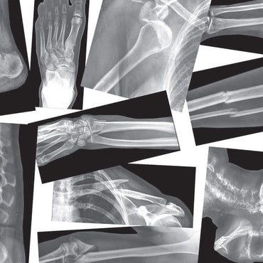 Broken Bones X-Ray Set, Pack of 15